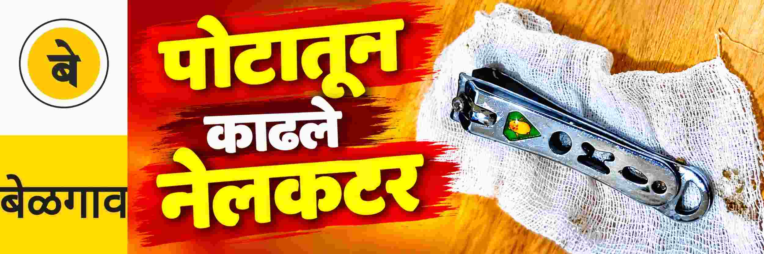 @ बेळगाव; पोटातून काढले नेलकटर
