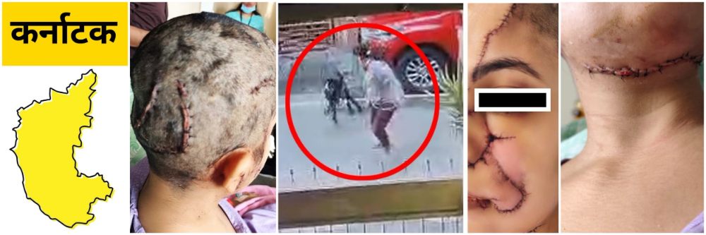 कर्नाटक; कुत्र्याचा महिलेवर भीषण हल्ला; चेहरा, गळ्यावर पडले 50 टाके