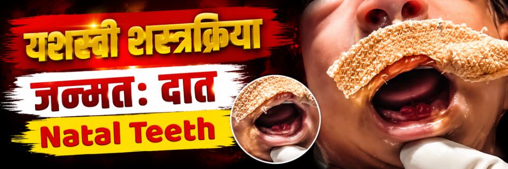 premature-baby-born-with-natal-teeth-treatment-doctors-perform-delicate-procedure-on-premature-newborn-with-rare-natal-teeth-condition-newborn-infant-with-a-visible-tongue-tie-ankyloglossia-newborn-202607_2.jpg | धक्कादायक पण अत्यंत दुर्मिळ; जन्मत: दात असलेलं 1 किलोचं बाळ | belgaum news | belgavkar बेळगावकर