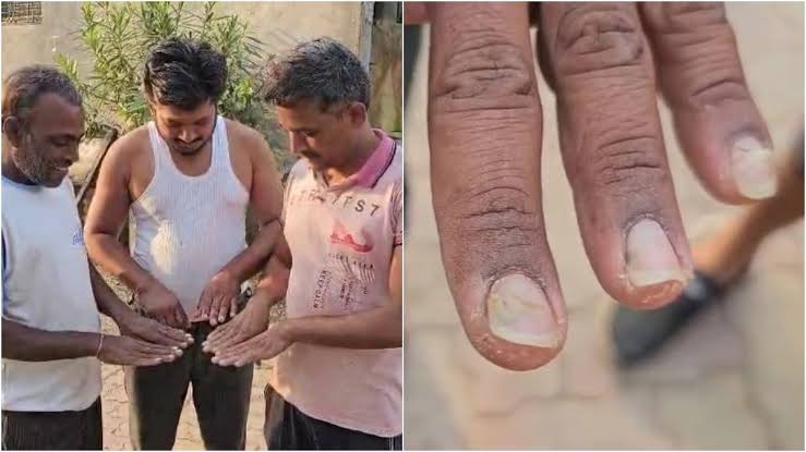 आता ‘नखगळती’; 46 जण बाधित; @शेगाव 5 गावांत लक्षणे
